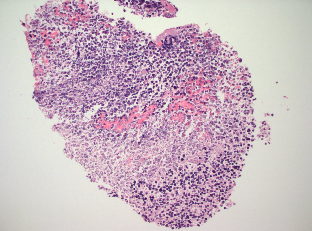 60s M h/o cutaneous leiomyosarcoma ~10yrs prior. Now with 6 cm lung mass and hilar adenopathy. Dx?

#PathX #PathTwitter #ThoracicPath