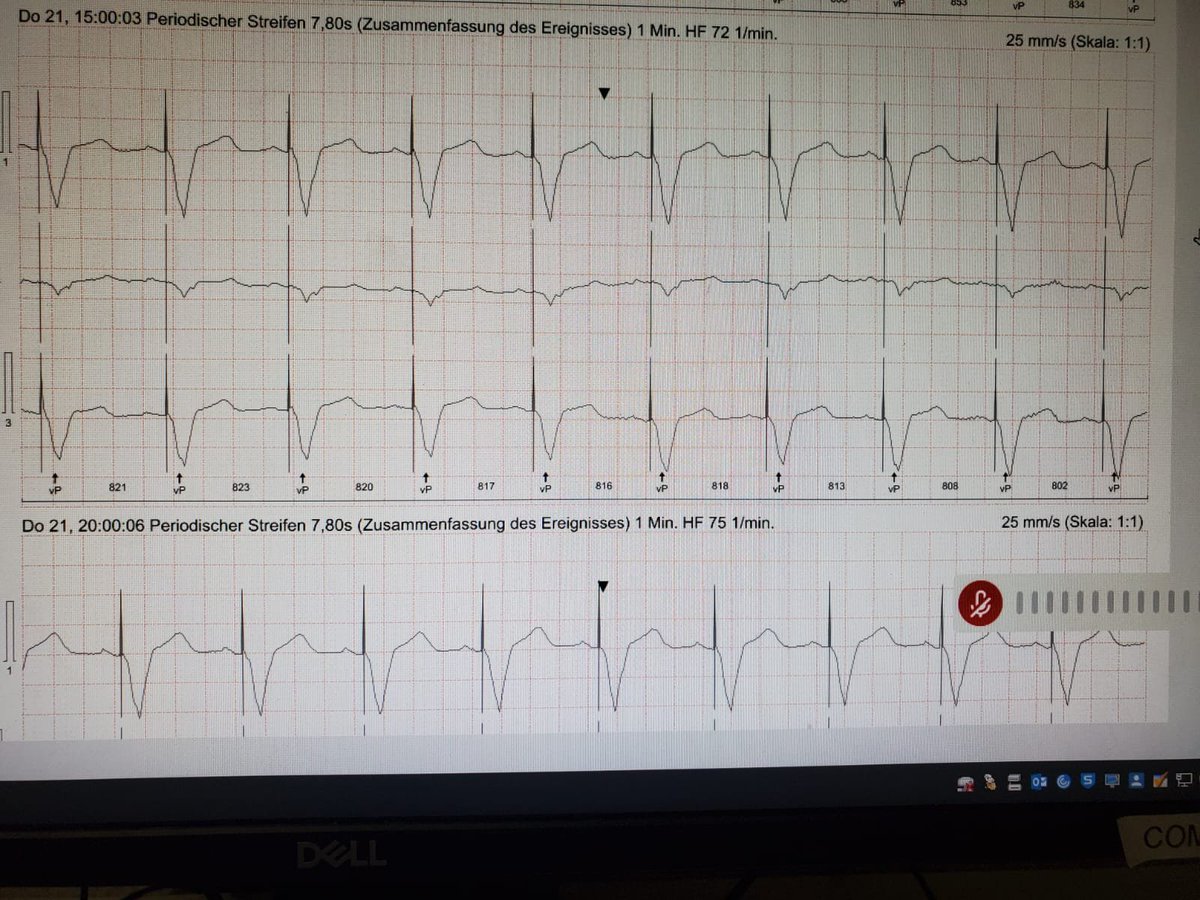 alexander degkwitz (@diggewitz) on Twitter photo Pat w/ DDD-PM for AVB II°, Holter for screening of Afib.
Dont understand why PM is pacing here at this intervall (red arrows)..can anyone help?
If there is a tracked P-wave hidden in T - why is AVI so long? (UTR 120/min I suppose)
<a href="/ecgandrhythmRoe/">Dr. Andreas Roeschl</a> <a href="/ecgrhythms/">Arnel Carmona</a> <a href="/EcgOxford/">🫀EcgOxford</a> #EPeeps Pat w/ DDD-PM for AVB II°, Holter for screening of Afib.
Dont understand why PM is pacing here at this intervall (red arrows)..can anyone help?
If there is a tracked P-wave hidden in T - why is AVI so long? (UTR 120/min I suppose)
<a href="/ecgandrhythmRoe/">Dr. Andreas Roeschl</a> <a href="/ecgrhythms/">Arnel Carmona</a> <a href="/EcgOxford/">🫀EcgOxford</a> #EPeeps