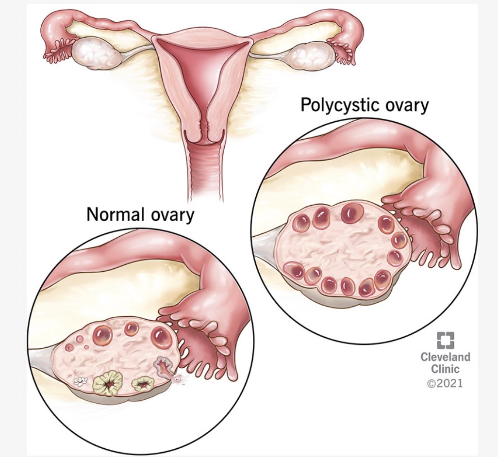 zizelle_'s tweet photo. CAN WOMEN WITH PCOS BEAR CHILDREN?

Imagine a situation where you’ve been unsuccessfully trying for a baby.

You went to a doctor, and was diagnosed with PCOS, but bad news is you have zero knowledge of the condition.

Where do you begin?

A comprehensive guide on PCOS 👇🏼 https://t.co/jFxCOA8kpS