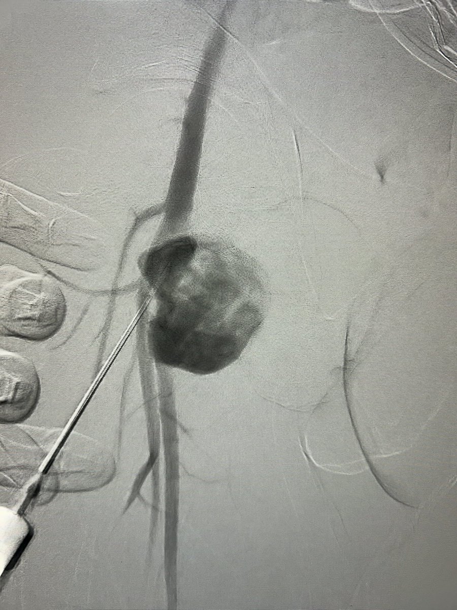 Angioseal for exclusion of post traumatic femoral artery pseudoaneurysm.