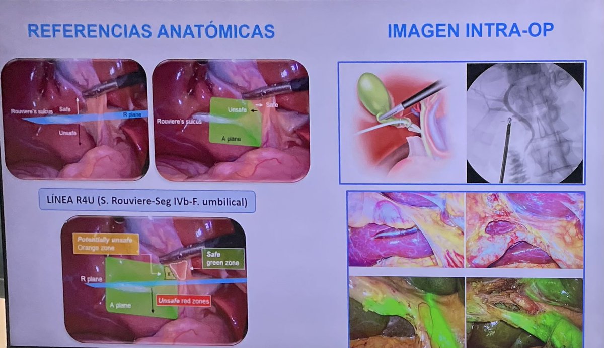 Cirurgia Althaia 🏥 (@cirurgiaalthaia) on Twitter photo Ahir, a la #sheilasessions, una sessió de MM del Dr <a href="/claudioguari/">Claudio Guariglia</a> amb molt bona revisió de lesions de la vis biliar👏👏💪
<a href="/ColleraPablo/">Pablo Collera</a> <a href="/sheilaserrapla/">sheilaserrapla</a> <a href="/RFarr15/">R. Farré</a> <a href="/cjGomez22/">Carlos Gómez</a> <a href="/mguell1/">mguell</a> <a href="/csotomontesinos/">Cristina Soto</a> <a href="/LSanchon/">Lorena Sanchon</a> <a href="/Regi70447447/">Regi</a> <a href="/AngelPuig13/">Angel Puig</a> <a href="/DrManelBardaji/">Manel Bardaji</a> <a href="/javier_curto/">Javi</a> Ahir, a la #sheilasessions, una sessió de MM del Dr <a href="/claudioguari/">Claudio Guariglia</a> amb molt bona revisió de lesions de la vis biliar👏👏💪
<a href="/ColleraPablo/">Pablo Collera</a> <a href="/sheilaserrapla/">sheilaserrapla</a> <a href="/RFarr15/">R. Farré</a> <a href="/cjGomez22/">Carlos Gómez</a> <a href="/mguell1/">mguell</a> <a href="/csotomontesinos/">Cristina Soto</a> <a href="/LSanchon/">Lorena Sanchon</a> <a href="/Regi70447447/">Regi</a> <a href="/AngelPuig13/">Angel Puig</a> <a href="/DrManelBardaji/">Manel Bardaji</a> <a href="/javier_curto/">Javi</a>