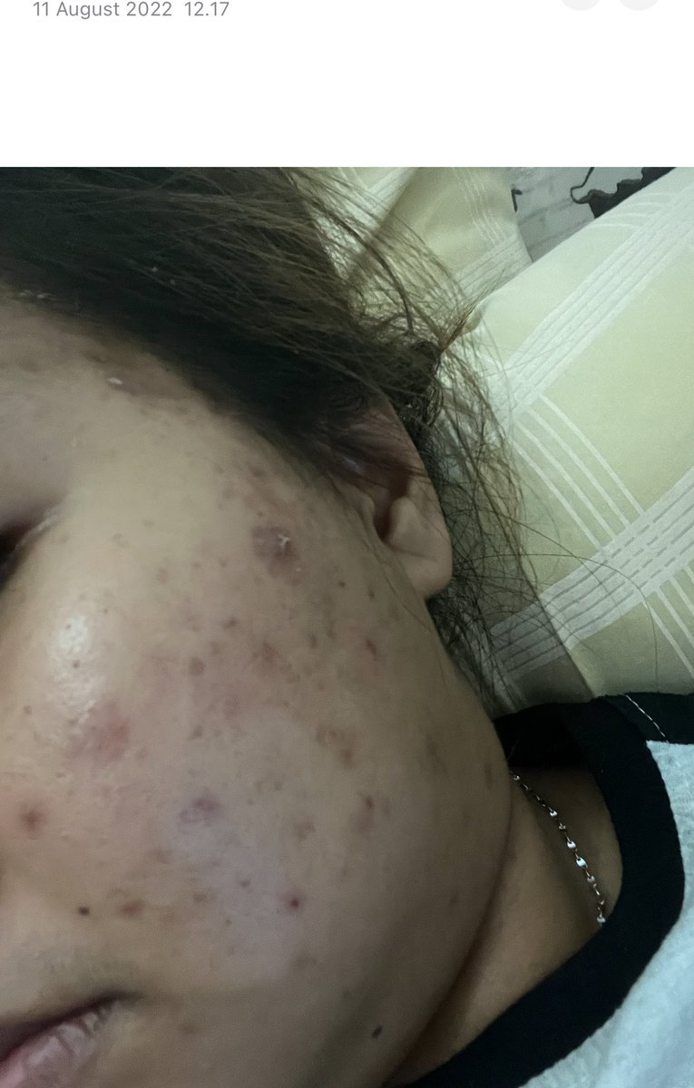 xarrrrrx's tweet photo. FROM
THIS                   TO                       THIS
Gimana cara aku sembuhin jerawat dan hilangin bekasnya! 
A THREAD https://t.co/WMxbS95R2z
