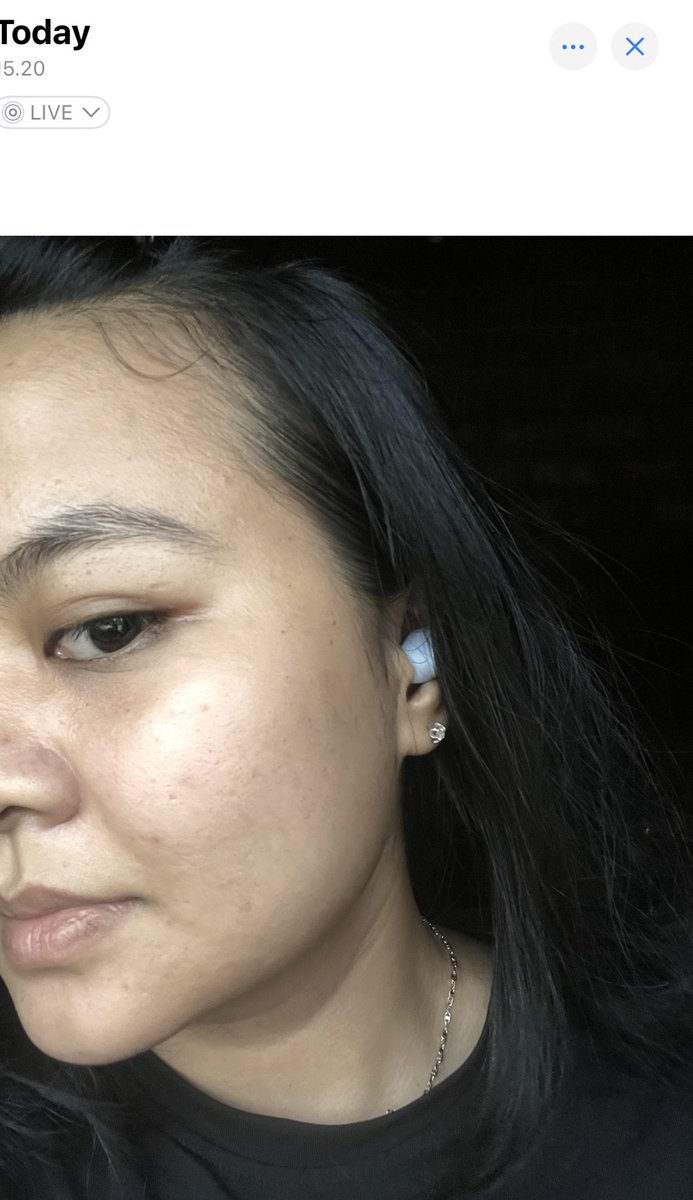 xarrrrrx's tweet photo. FROM
THIS                   TO                       THIS
Gimana cara aku sembuhin jerawat dan hilangin bekasnya! 
A THREAD https://t.co/WMxbS95R2z