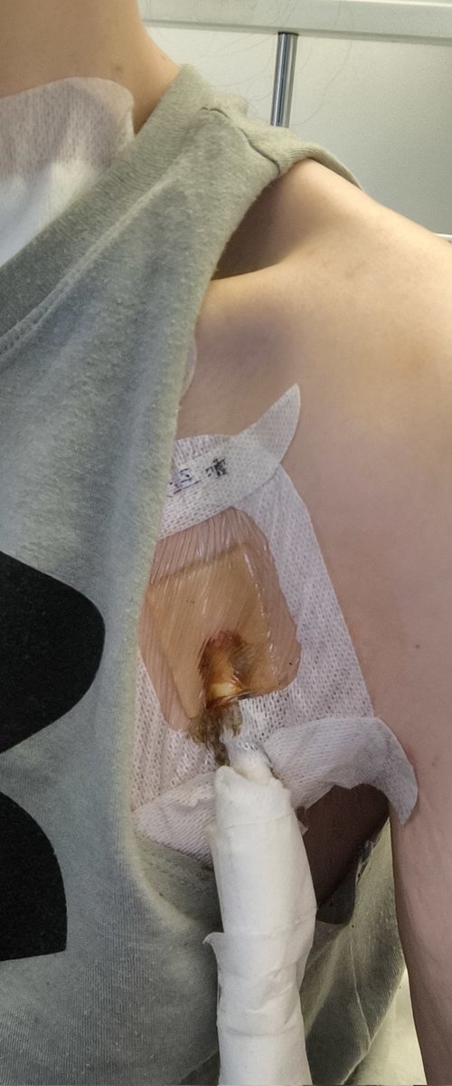 I BEGGED for help to access safe, appropriate care for Stage 5 CKD.

I was dismissed like my life doesn't matter. 💔 

I'm now having treatment as an in-patient in 🏥. This costs MULTIPLES of the treatment I need &amp; is much harder on my body.🤦🏻‍♀️

Use your vote wisely. #GE2024