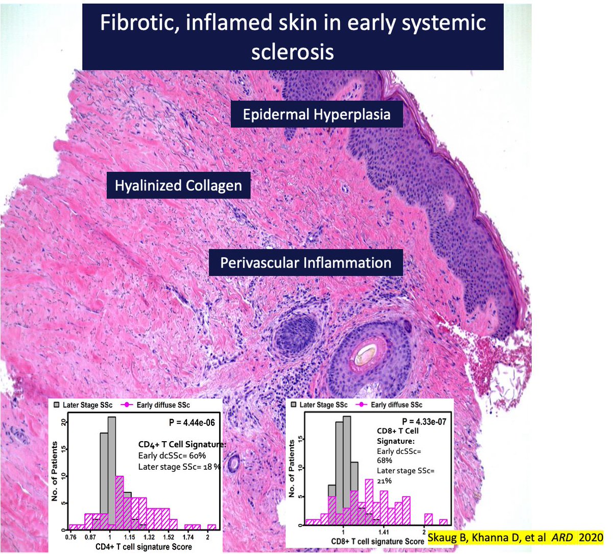 sclerodermaUM's tweet image. #scleroderma 
1. why is SSc- a &apos;fibrotic disease&apos; treated with immunosuppressive?
2. Why dont every patient with early SSc respond to immunosuppressive? 
the lessons lie in understanding the underlying mechanisms of early SSc and molecular heterogeneity.  @IRACON24Blr