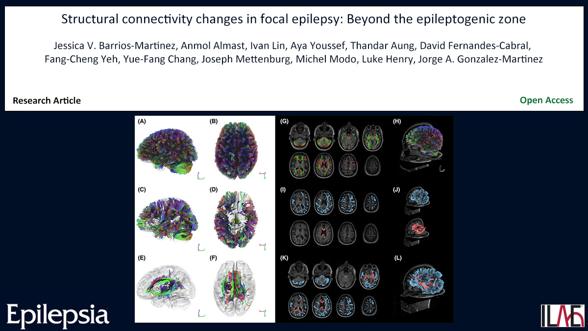 EpilepsiaJourn's tweet photo. Key point: Differential tractography detects differences in structural connectivity when individual patients are compared with a control population.
https://t.co/UINcfvVLwl

#epilepsy #ILAE #biomarker #diffusionMRI #structuralconnectivity @IlaeWeb @WileyNeuro @epilepsiajourn https://t.co/YsMaKhJRi5