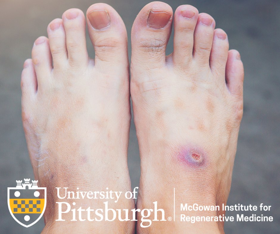 Dr. Ghatak from the McGowan Institute for Regenerative Medicine has uncovered a natural solution that could transform wound care. 🔬 Read full article here: smpl.is/9vv3e
 #MedicalInnovation #ChronicWounds #RegenerativeMedicine #McGowanInstitute #HopeForHealing