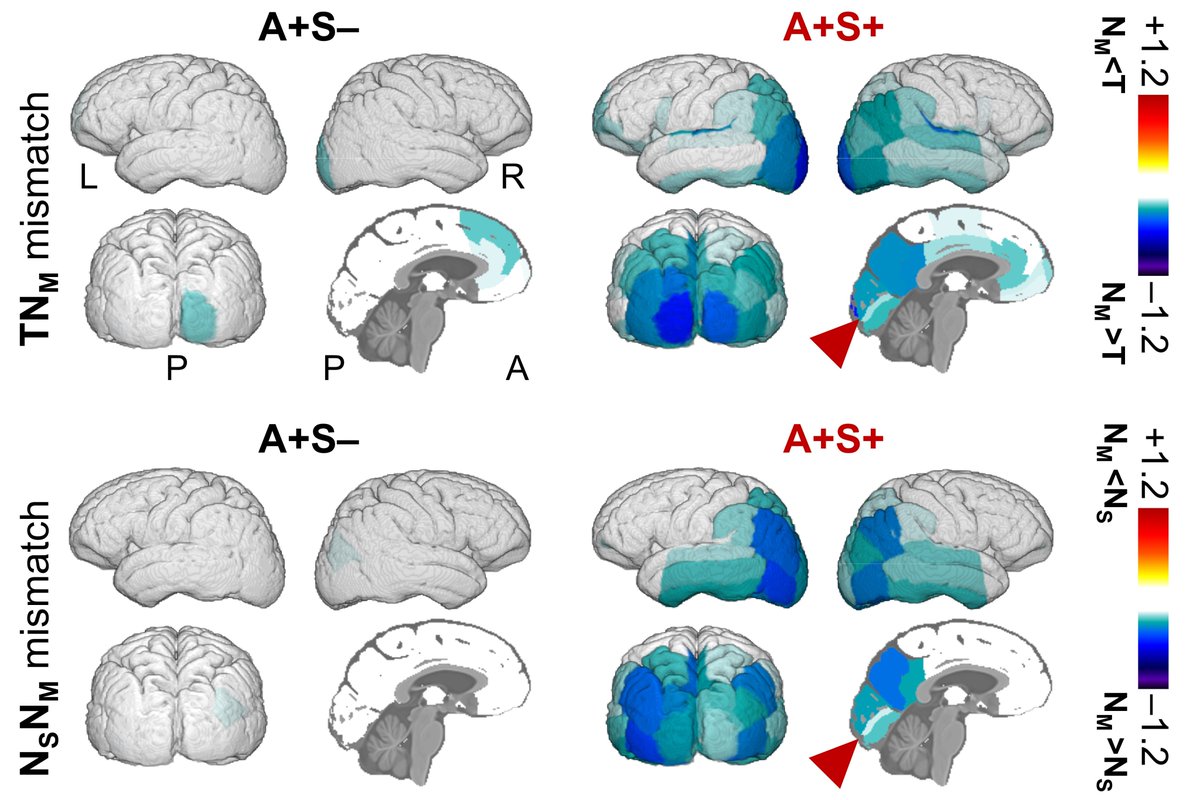 Brain1878's tweet photo. Duong et al. report that patients with mixed Alzheimer’s and Lewy body disease show a signature pattern of posterior hypometabolism that is disproportionate to the degree of atrophy on MRI and tau pathology as measured by PET. https://t.co/p2Eh3Vh7mN https://t.co/76FSOX5CLF