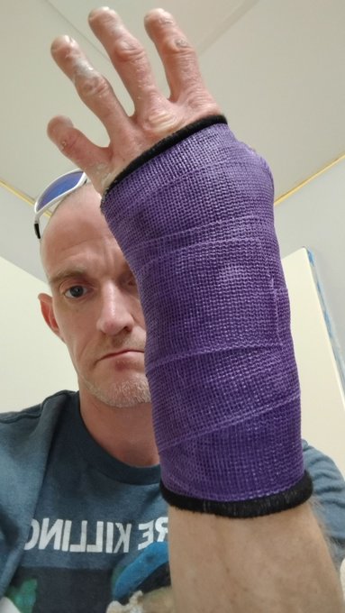 Roboninja Brian Fraase - Wrist broken in accident on my ebike and have surgery the 2nd I can't do anything with my right hand and it sucks learning how to do everything with my left. No work for 6 weeks so financially need help https://t.co/hZHWI4UIRl