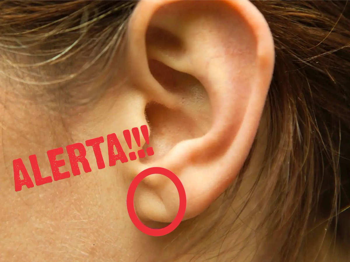 amandaferd_psic's tweet photo. 🚨 ATENCION 🚨
¿TIENES UN PLIEGUE EN LA OREJA? 👂

¿Sabías que un pliegue en tu oreja podría ser un indicio de riesgo de infarto? 🏥💓

Descubre mas información en el siguiente
🧵⚕️👇👇

#SaludCardiovascular #SignosDeInfarto #ConsejosDeSalud https://t.co/wEjBAMzmiB