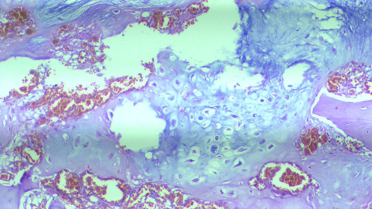 Here are the photomicrographs. 
<a href="/Dina_hussein94/">Dina Hussein</a> <a href="/DanGrahamMD/">Dan Graham</a> <a href="/RibianszkyA/">Annamária Ribiánszky, MD</a> <a href="/JacobBizuneh/">Yacob Bizuneh</a> <a href="/DrDanok/">Daniel</a> <a href="/Pathologists/">CAPathologists</a> #BSTpath