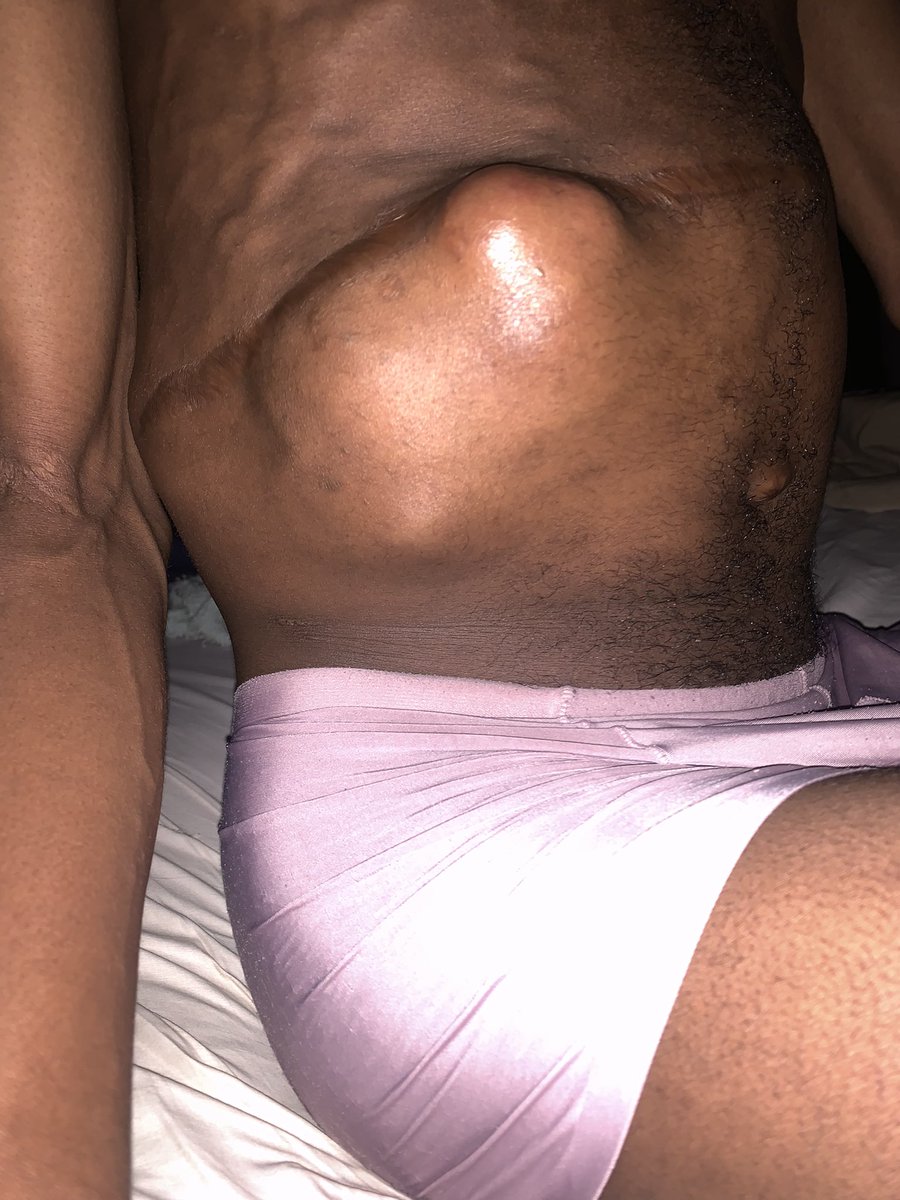 <a href="/_DebbieOA/">MumZee✨🇳🇬</a> Good afternoon <a href="/_DebbieOA/">MumZee✨🇳🇬</a> and everyone reading this
I’m a cancer patient and I have been struggling with it for years but right now I can’t afford to pay for drugs and other treatment 
Please I need financial support to go for radiotherapy cancer treatment 
Please help me