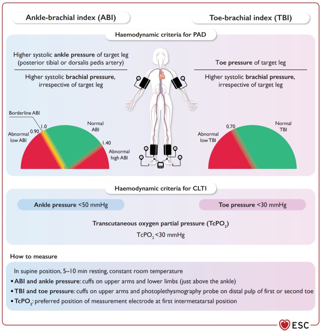 🔴Evaluation of  Peripheral Arterial Disease⤵️  2024 ESC Guidelines 

🔹Ankle Brachial Index (ABI)

🔹escardio.org/Guidelines/Cli…
 #Cardiology #FOAMed #MedEd #medstudent #paramedic #Cardiology #CardioEd #medtwitter #meded #CardioTwitter #cardiotwiteros  #MedX #cardiovascular