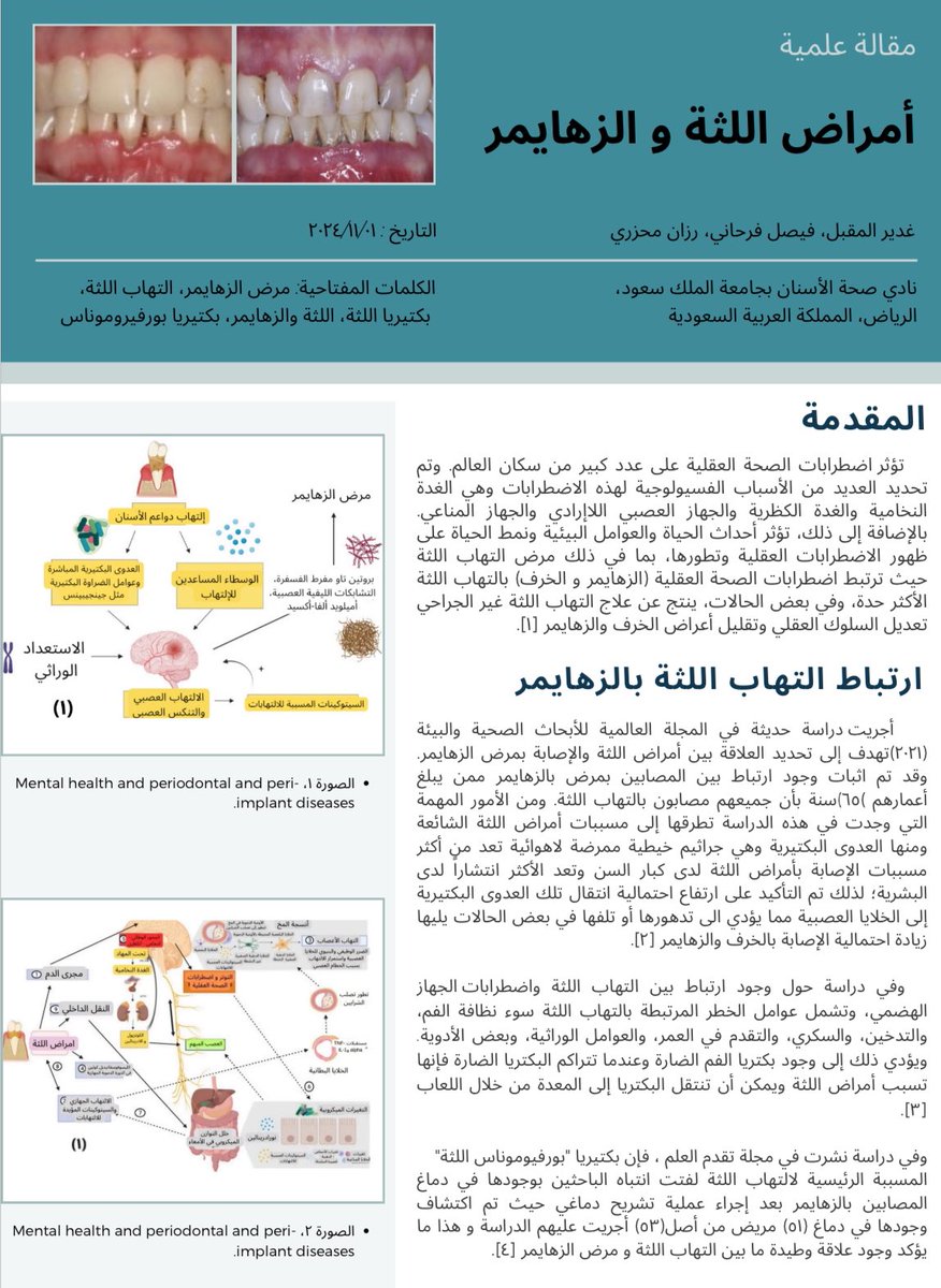 نشارككم ثاني مقالاتنا العلمية من لجنة الأبحاث العلمية عن أمراض اللثة والزهايمر 📑
باللغتين العربية والإنجليزية 🔎

نتمنى لكم قراءة ممتعة وعلماً نافعاً.
#نادي_صحة_الأسنان

drive.google.com/drive/folders/…