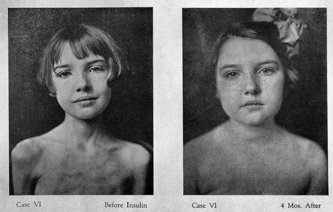 Une histoire de #médecine : 
En 1922, un groupe de scientifiques se rend à l'hôpital général de Toronto où sont gardés les enfants diabétiques, souvent à 50 ou plus dans de grandes salles. La plupart d'entre eux sont dans le coma et s’éteignent d'une acidocétose diabétique.