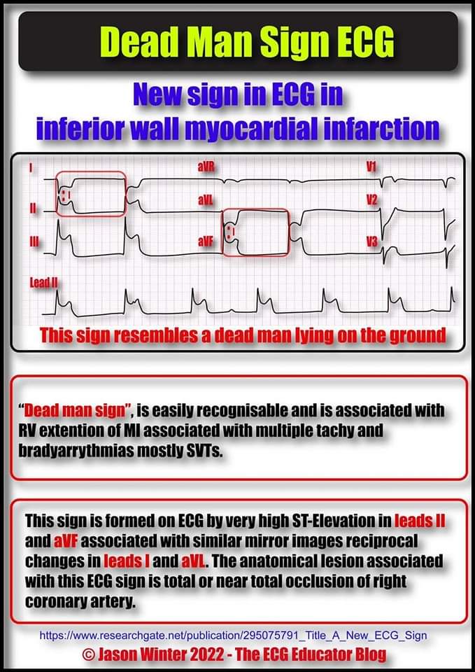 🔴Dead Man Sign of ECG⤵️
🔹The ST segment elevation in aVF and ST segment depression in aVL combinedly giving appearance of a “DEAD MAN SIGN” (dead man lying on ground).

🔹scitechnol.com/peer-review/de…