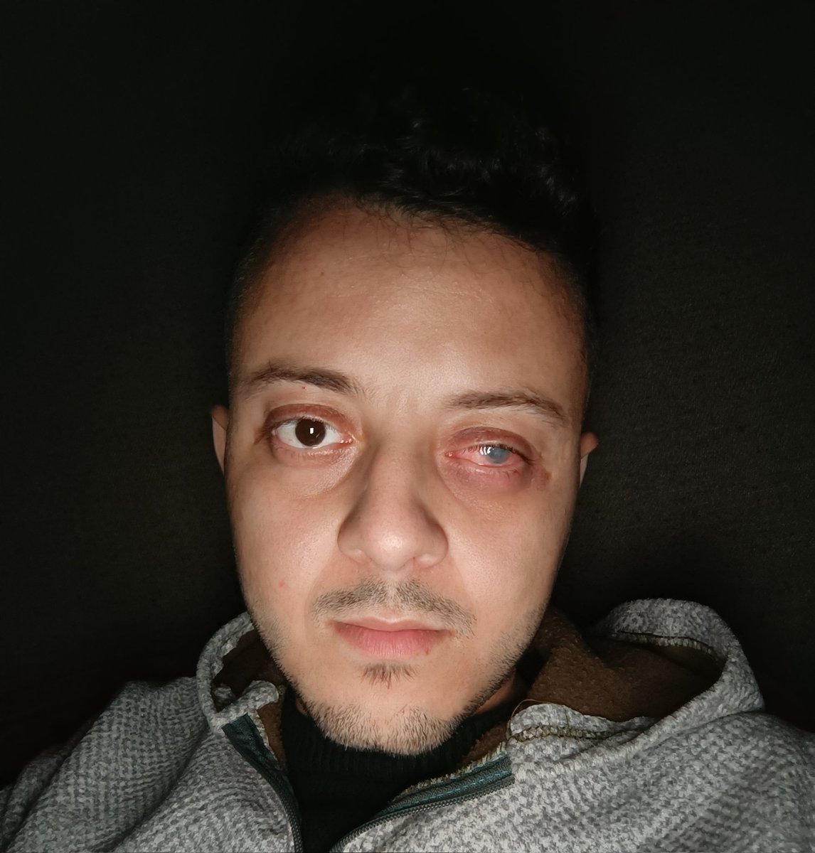 My eye is sitill hurting me, and i live a worst nightmare 😭
Please pray for me. 
gofund.me/3fd33d14