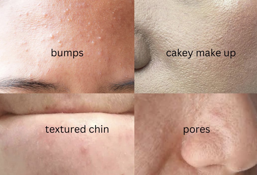_zhraxs's tweet photo. rupanya cara paling basic nak fix most of skin concerns is to exfoliate

bila bumps &amp; textured skin hilang, pores mengecil, barulah kulit smooth &amp; make up jadi cantik https://t.co/K4OseAVWGS
