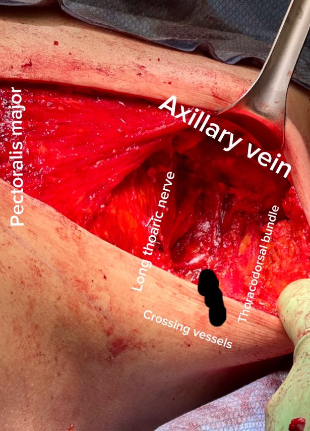 Boundries of an axillary dissection 

axillary vein superiorly, the serratus medially,latissimus laterally, clavipectoral fascia anteriorly , crossing vessel inferiorly and the subscapularis posteriorly

Critical structures : 
Thoracodorsal &gt;&gt; Lat Dorsi
Long thoracic &gt; serratus