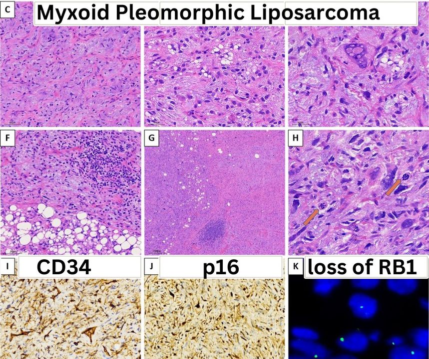 ⛳ Myxoid and pleomorphic liposarcoma
⛳ CREB5::TERT fusion ❇️ AND❇️  ETV1::LFNG rearrangements
bit.ly/3X6PVWi