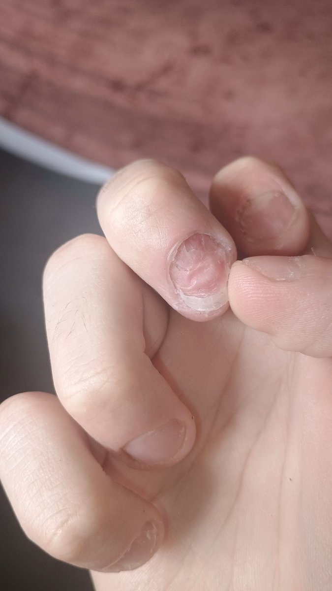 Retrogamer72's tweet photo. TMI, y'all ever get this problem? #hangnail #fingers #nails #pain #foryoupage #gross #painful
You've seen my feet, now you've seen my fingers. https://t.co/4qfx95gRTm