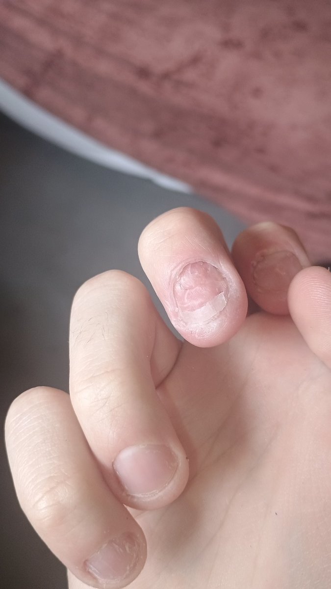 Retrogamer72's tweet photo. TMI, y'all ever get this problem? #hangnail #fingers #nails #pain #foryoupage #gross #painful
You've seen my feet, now you've seen my fingers. https://t.co/4qfx95gRTm