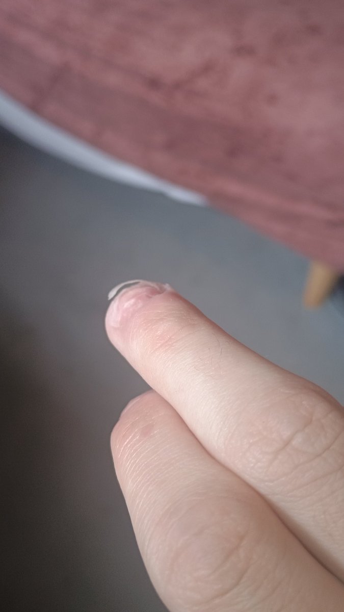 Retrogamer72's tweet photo. TMI, y'all ever get this problem? #hangnail #fingers #nails #pain #foryoupage #gross #painful
You've seen my feet, now you've seen my fingers. https://t.co/4qfx95gRTm