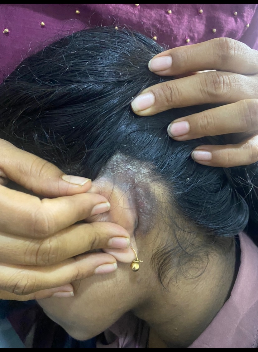 DietDrsayajirao's tweet photo. Seborrheic dermatitis??

Seborrheic Eczema??

Here is case of 16 years old girl with skin eruptions behind ear since last 10 years.

Symptoms:
 
Scaly red skin behind ear.
Itching.
Sometimes sticky discharge.
Dandruff.
Black discolouration around neck.
Obesity.
Pimples on face.

Had tried all types of medicines with no results.

She had typical signs of insulin resistance.

Her blood investigations 

Fasting insulin 11.35 
Vitamin D 6.94 MH/mL

What I have done:

Stopped wheat products.
Stopped all outside food.
Stopped sugar and seed oils.
Started protein powder.
Started three eggs a day.
Started homeopathic medicines.

Result : within four months 

All skin eruption gone.
Pimples gone.
Black discolouration around neck improved.
Her confidence level improved.
She lost 7kg weight.
No dandruff.

Most skin eruption heal better with low carb high protein diet if practiced with discipline and consistency.

#insulin resistance 
#eczema
#acne
#LCHP