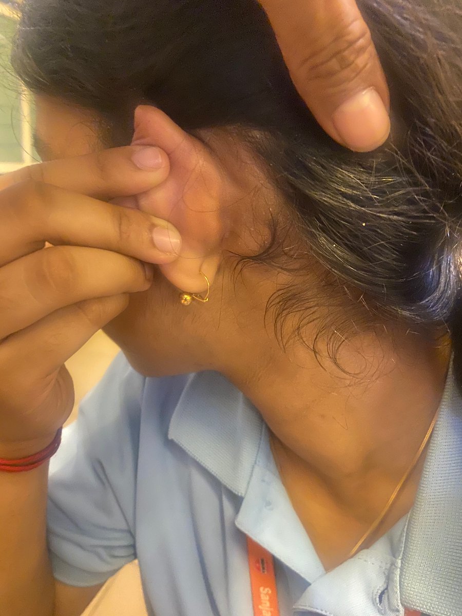 DietDrsayajirao's tweet photo. Seborrheic dermatitis??

Seborrheic Eczema??

Here is case of 16 years old girl with skin eruptions behind ear since last 10 years.

Symptoms:
 
Scaly red skin behind ear.
Itching.
Sometimes sticky discharge.
Dandruff.
Black discolouration around neck.
Obesity.
Pimples on face.

Had tried all types of medicines with no results.

She had typical signs of insulin resistance.

Her blood investigations 

Fasting insulin 11.35 
Vitamin D 6.94 MH/mL

What I have done:

Stopped wheat products.
Stopped all outside food.
Stopped sugar and seed oils.
Started protein powder.
Started three eggs a day.
Started homeopathic medicines.

Result : within four months 

All skin eruption gone.
Pimples gone.
Black discolouration around neck improved.
Her confidence level improved.
She lost 7kg weight.
No dandruff.

Most skin eruption heal better with low carb high protein diet if practiced with discipline and consistency.

#insulin resistance 
#eczema
#acne
#LCHP