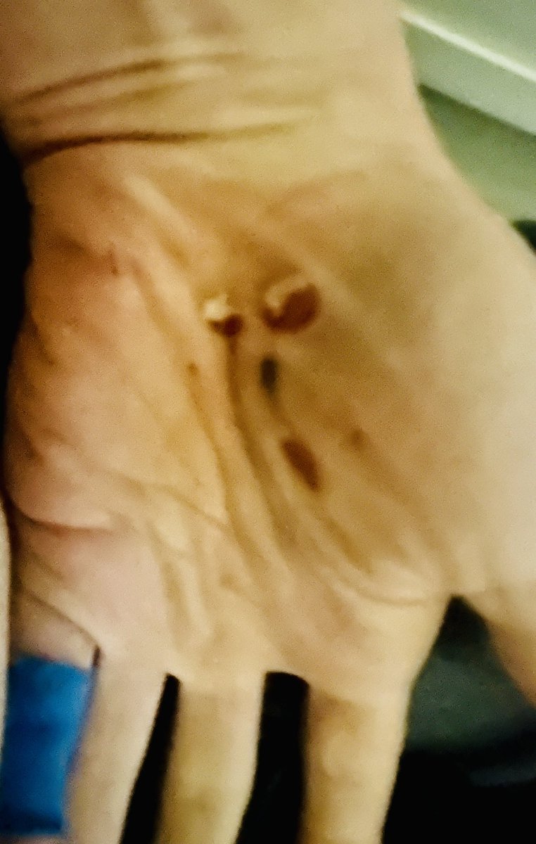 KernelKickAss's tweet image. Had a bicycling accident and now my hand looks like the grinch…happy holidays 🎄
