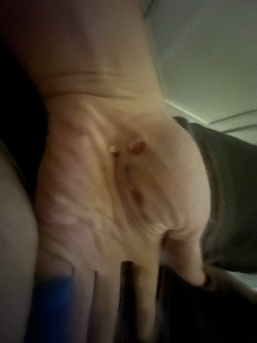 KernelKickAss's tweet image. Had a bicycling accident and now my hand looks like the grinch…happy holidays 🎄