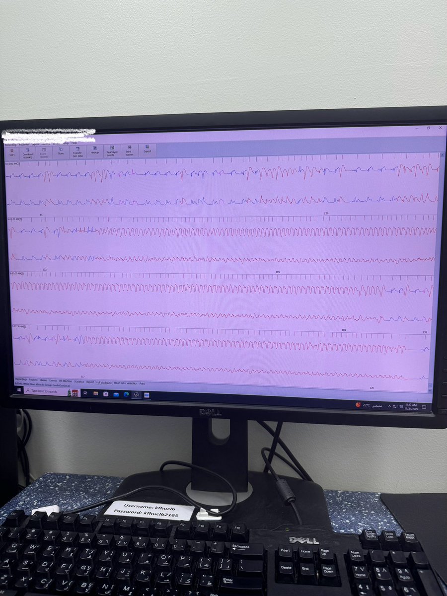 NANIs39x's tweet photo. 24.11.2024
Patient with atypical chest pain and syncopal attack
Holter showed:
Sustained ventricular tachycardia,MI,shark fin sign caused by acute coronary occlusion https://t.co/jXbSDVkwhY