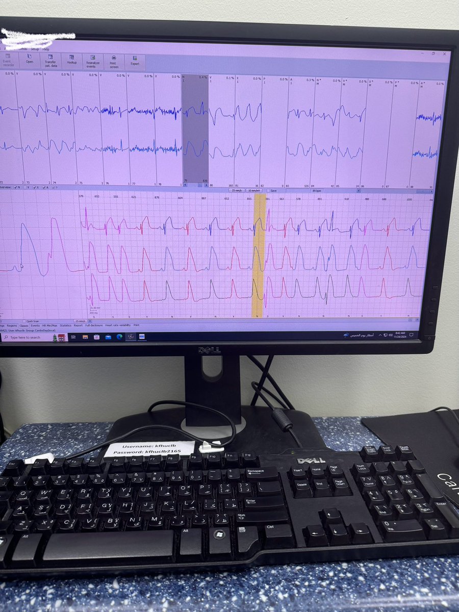 NANIs39x's tweet photo. 24.11.2024
Patient with atypical chest pain and syncopal attack
Holter showed:
Sustained ventricular tachycardia,MI,shark fin sign caused by acute coronary occlusion https://t.co/jXbSDVkwhY