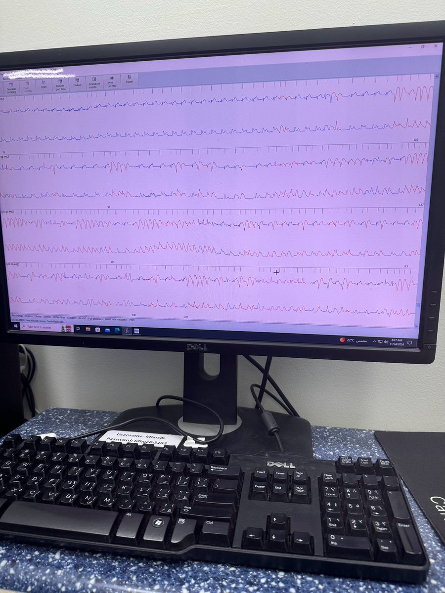 NANIs39x's tweet photo. 24.11.2024
Patient with atypical chest pain and syncopal attack
Holter showed:
Sustained ventricular tachycardia,MI,shark fin sign caused by acute coronary occlusion https://t.co/jXbSDVkwhY