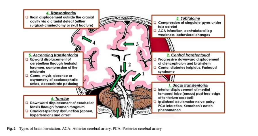 Leo_Santo5's tweet photo. 💎Manejo de la Hipertensión Intracraneal en UCI🧠🏥

🔰📚Journal of Anesthesia

https://t.co/GP7TAd7zsz

Enlace a Artículo Completo 👇🏽🆓✅https://t.co/xumUMHaxVK https://t.co/KkbzTiWr5a