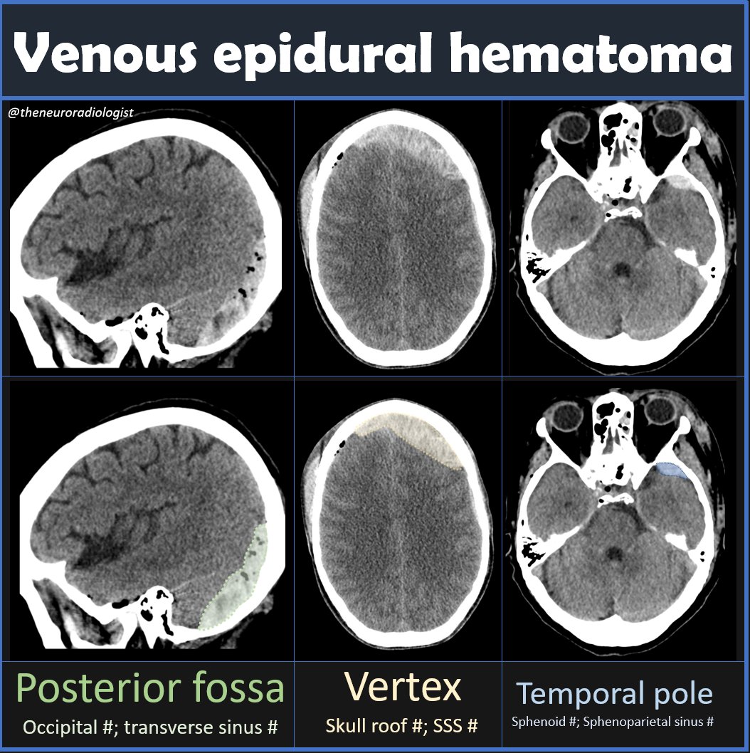 theneuroradguy's tweet photo. Venous epidural hematoms constitute about 25% of epidural hematomas, look like arterial EDHs (lensshaped), but can be found in three very typical locations: the posterior fossa, near the vertex and near the temporal pole #radiology #neuroradiology #RADed #FOAMrad #MEDed #FOAMed https://t.co/RRRSswWryr