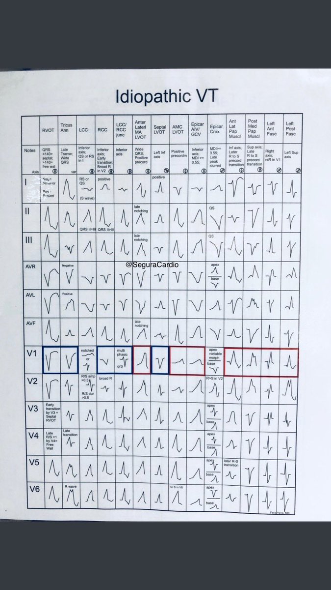 How to locate source of origin of Ventricular Tachycardia⚡️‼️

#CardioEd