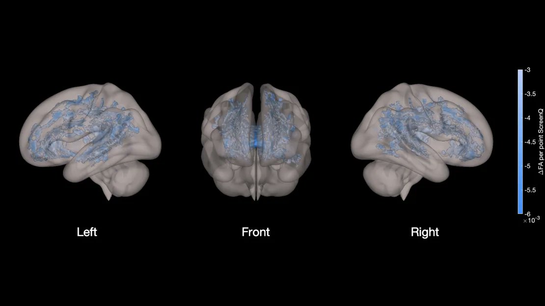 Screen time is linked to lower brain development in kids.

🧵1/10