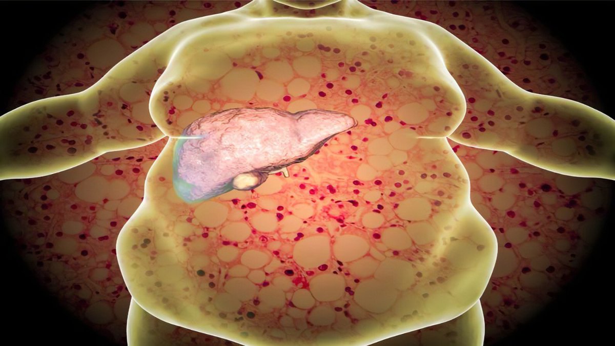 🧵COMO SANAR EL HÍGADO GRASO

El hígado es el segundo órgano más grande del cuerpo. Es nuestra central de procesado y filtrado de nutrientes, alimentos, bebidas y elimina sustancias tóxicas.

Nos cuida y defiende, cuidémoslo a el ⬇️