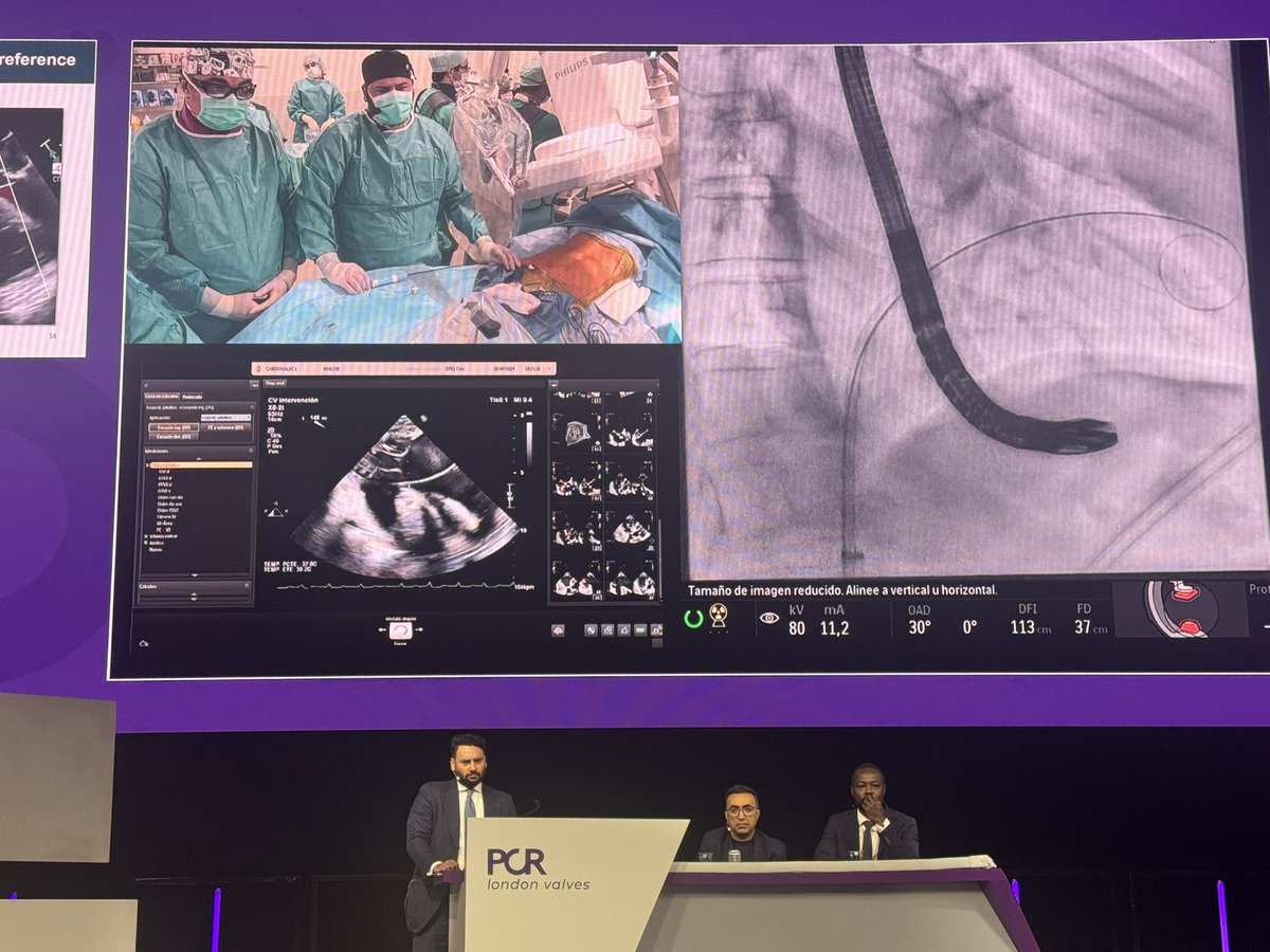 Julio Echarte (@jcecharte) on Twitter photo 🌟Great way to start at #PCRLV Main Arena: Innovation for transcatheter tricuspid interventions <a href="/azeemlatib/">Azeem Latib</a> <a href="/didier_tchetche/">Didier Tchetche</a> <a href="/PhilippLurz/">Philipp Lurz</a> <a href="/hahn_rt/">RTHahnMD</a> <a href="/modine_thomas/">thomas modine</a> <a href="/PCRonline/">PCRonline 🫀</a>
🎯Live TTVR case with Evoque system
🎯 Recorded TTVR case with Cardiovalve presented by <a href="/RodrigoEstvez1/">Rodrigo Estévez</a> 🌟Great way to start at #PCRLV Main Arena: Innovation for transcatheter tricuspid interventions <a href="/azeemlatib/">Azeem Latib</a> <a href="/didier_tchetche/">Didier Tchetche</a> <a href="/PhilippLurz/">Philipp Lurz</a> <a href="/hahn_rt/">RTHahnMD</a> <a href="/modine_thomas/">thomas modine</a> <a href="/PCRonline/">PCRonline 🫀</a>
🎯Live TTVR case with Evoque system
🎯 Recorded TTVR case with Cardiovalve presented by <a href="/RodrigoEstvez1/">Rodrigo Estévez</a>