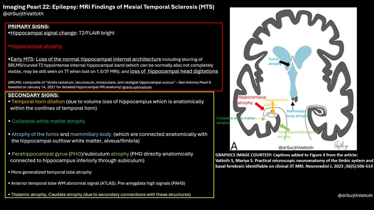 drSurjthVattoth's tweet photo. Imaging Pearl 22: EPILEPSY: MRI Findings of Mesial Temporal Sclerosis (MTS) Graphics: MTS Primary & Secondary signs
Will follow up soon with retweets of my prior Hippocampal Anatomy & Temporal Lobe Anatomy "Anatomy Pearl" slides
#FOAMed #foamrad #epifelchat #epilepsy #medicaleducation #MedTwitter #medicalstudent #radres #neurorad #neuroscience #Neurology #neurosurgery