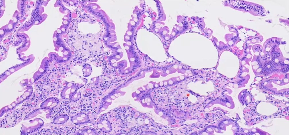 Janiranavarro's tweet photo. 57yo with abdominal pain/diarrhea
EGD: Normal esophagus/stomach/duodenum
H&E: Rare groups of macrophages and dilated lacteals
PAS + macrophages
Diagnosis? See next post 👇
Dr. Zhang #CAP24 #pathology #pathologists #PathTwitter #PathX #pathresidents #pathfellow #GIpath https://t.co/nATCgF8jlD