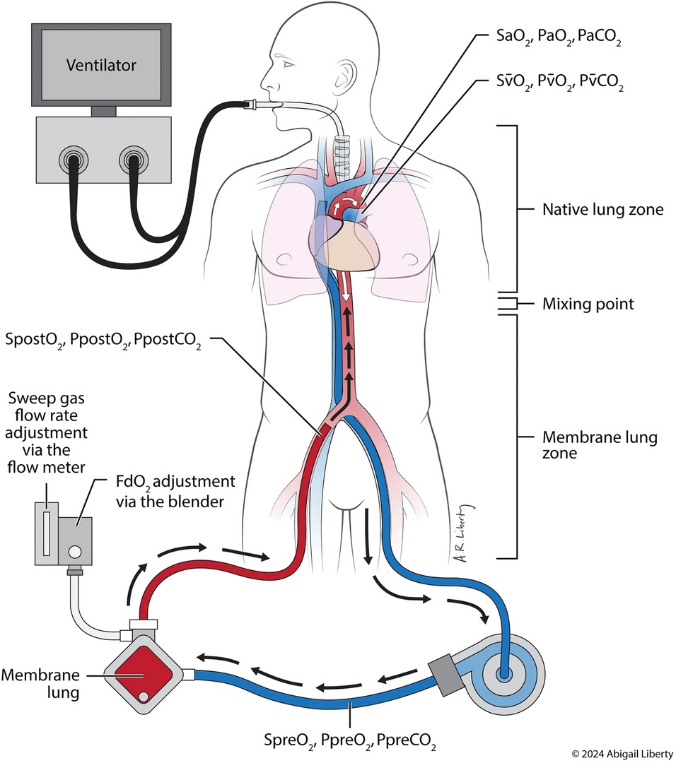 ZHeart11768530's tweet photo. 🔴Position paper on the physiology and nomenclature of dual circulation during venoarterial ECMO in adults⤵️ #2024Review 

🔹https://t.co/9Kiy5mxL5d
#ECMO #VA #ECLS #Dualcirculation #NativeVsMembrane #ManVsMachine
#POCUS #Cardiology #FOAMed #MedEd #medstudent #paramedic https://t.co/XfaXyYvZfK
