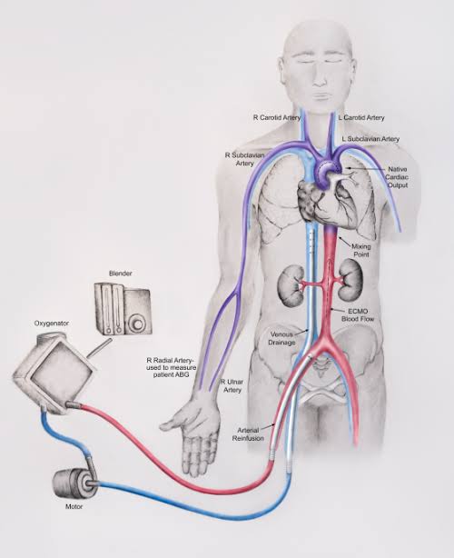 ZHeart11768530's tweet photo. 🔴Position paper on the physiology and nomenclature of dual circulation during venoarterial ECMO in adults⤵️ #2024Review 

🔹https://t.co/9Kiy5mxL5d
#ECMO #VA #ECLS #Dualcirculation #NativeVsMembrane #ManVsMachine
#POCUS #Cardiology #FOAMed #MedEd #medstudent #paramedic https://t.co/XfaXyYvZfK