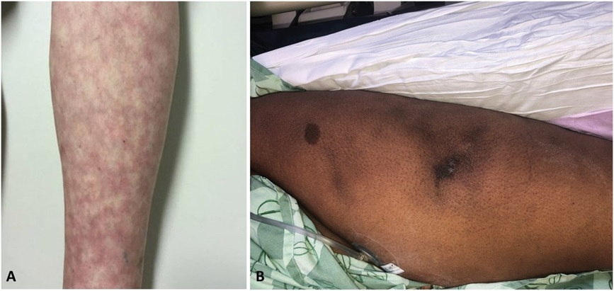 AJDP_Journal's tweet photo. #WhatsNewInDermpath
Calciphylaxis as a uniquely bone forming subcutaneous C5b-9–mediated microvascular injury syndrome associated with localized subcutaneous and systemic complement pathway activation
Figure 3 A&B: Microvascular deposition of C5b-9
@WolnerZachary @TKalomeris https://t.co/qSQuvA5xW2