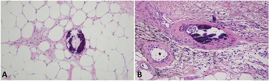 AJDP_Journal's tweet photo. #WhatsNewInDermpath
Calciphylaxis as a uniquely bone forming subcutaneous C5b-9–mediated microvascular injury syndrome associated with localized subcutaneous and systemic complement pathway activation
Figure 3 A&B: Microvascular deposition of C5b-9
@WolnerZachary @TKalomeris https://t.co/qSQuvA5xW2