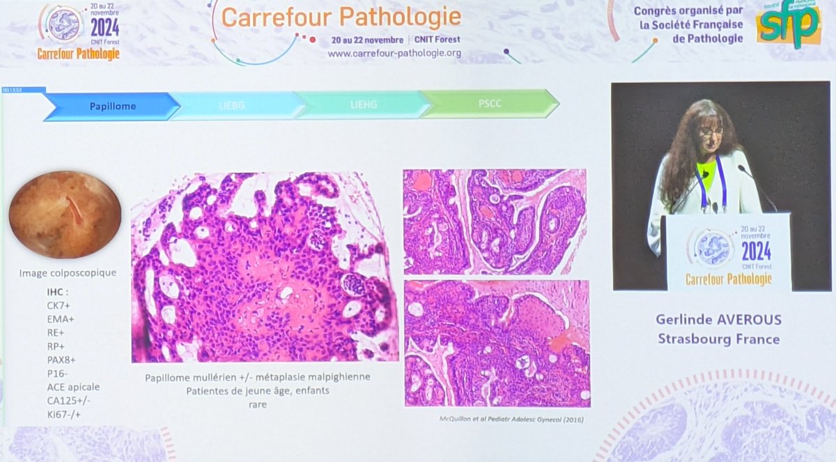 Col &amp; co par Dr Just Pierre-Alexandre Dr Gerlinde Avérous et Dr Sébastien Henno ?
#CarrefourPathologie2024 #CP2024
#Gynpath