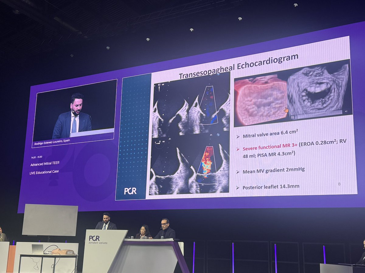 Julio Echarte (@jcecharte) on Twitter photo 💥Full house in the Main Arena for Advanced Mitral TEER. <a href="/RodrigoEstvez1/">Rodrigo Estévez</a> just presented a TEER case with the use of Dragonfly device⚡️
🎯More devices for more patients <a href="/PCRonline/">PCRonline 🫀</a> #PCRLV 💥Full house in the Main Arena for Advanced Mitral TEER. <a href="/RodrigoEstvez1/">Rodrigo Estévez</a> just presented a TEER case with the use of Dragonfly device⚡️
🎯More devices for more patients <a href="/PCRonline/">PCRonline 🫀</a> #PCRLV