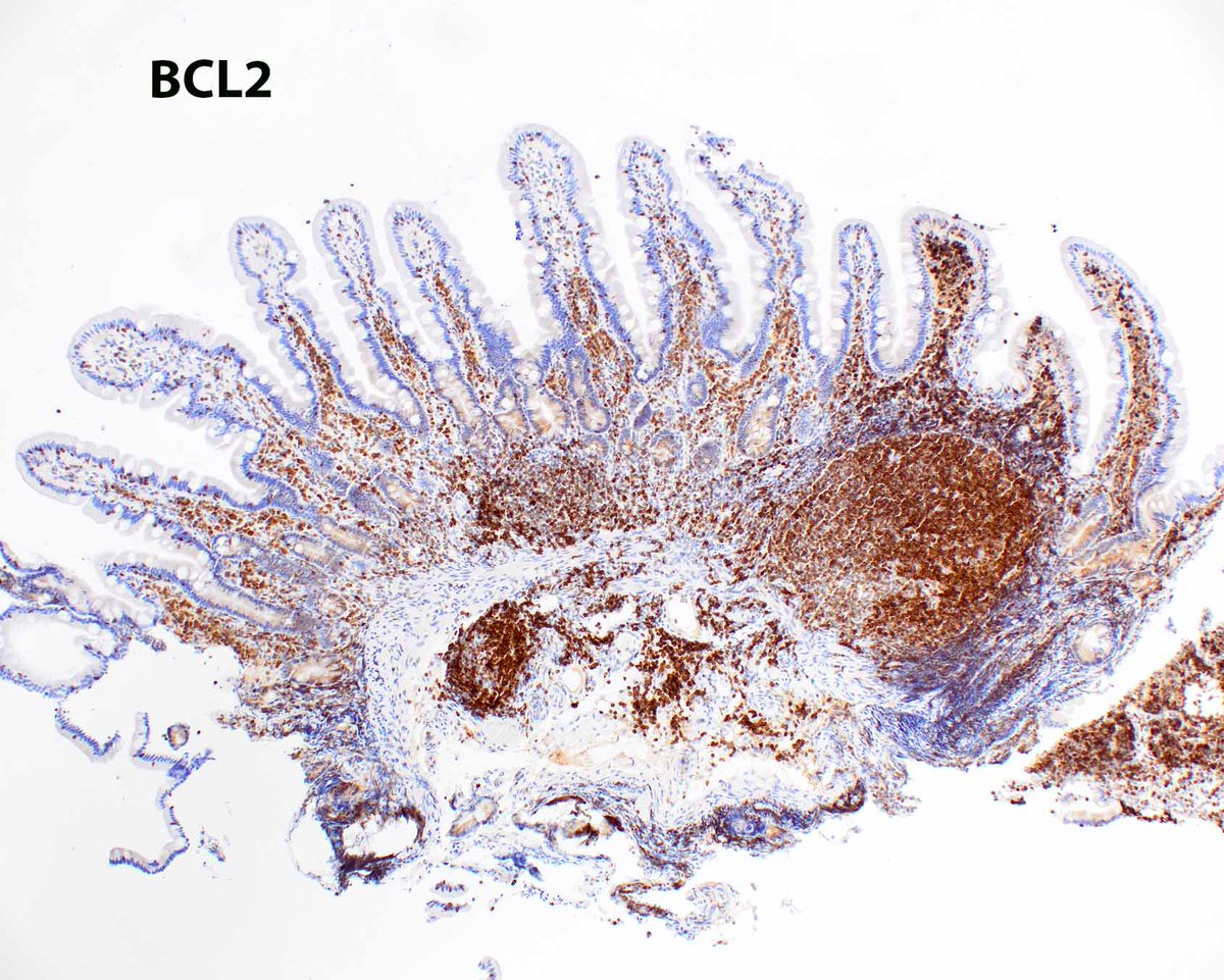 Duodenal type follicular lymphoma is indolent,  managed by observation. Note aberrant BCL2 expression within a neoplastic follicle (right).
Marks E, Shi Y. Duodenal-Type Follicular Lymphoma: A Clinicopathologic Review. Arch Pathol Lab Med. 2018 Apr;142(4):542-547. PMID: 29565210.