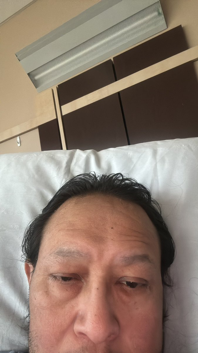 Well, this has been a short, high-speed, and intense journey over the last week. Went from feeling bad, to finding out I had a heart attack, to finding out I had to have quadruple bypass surgery. Well, they just pulled out the last chest tube. On track to go home tomorrow.